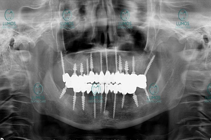 Full Mouth dental implant