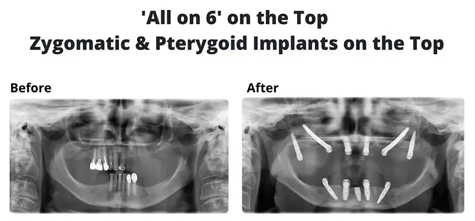 ZYGOMATIC IMPLANTS PTERYGOID IMPLANTS A COMPREHENSIVE GUIDE TO ADVANCED DENTAL SOLUTIONS