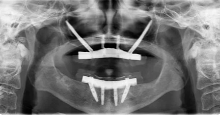  Zygomatic Implants: A Game-Changer for Those with Severe Bone Loss