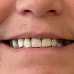 Permanent Fixed Teeth with Basal Implants in Hyderabad Lumos Dental Care