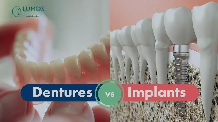 Dentures vs. Implants