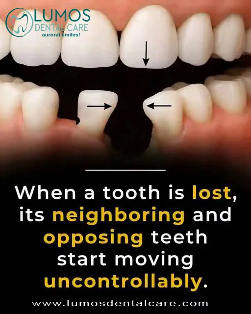 Losing a tooth is more than just a cosmetic issue